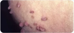 اثرات واکسن گارداسیل