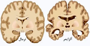 زوال عقل