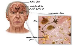 بیماری الزایمر