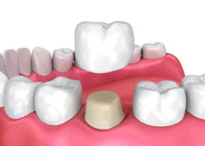 روکش تمام سرامیک دندان