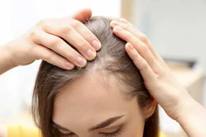 پیشگیری و درمان ریزش موی آندروژنیک یا ریزش مو ارثی
