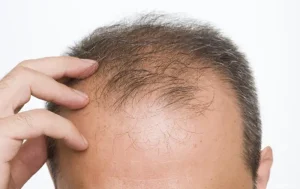 جلوگیری از ریزش مو ارثی