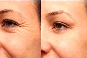 علتهای چین و چروک زودرس پوست و راههای پیشگیری