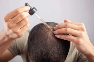 عوارض جانبی داروهای ریزش مو