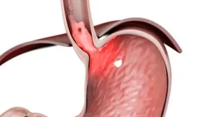 چه زمانی علت رفلاکس معده خطرناک است؟
