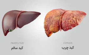 احساس خستگی مزمن و درد سمت راست شکم ناشی از کبد چرب