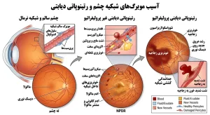 آسیب مویرگ‌های شبکیه چشم و رتینوپاتی دیابتی