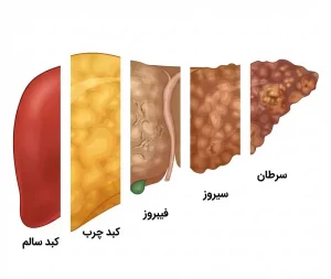 مراحل پیشرفت کبد چرب از استاتوز تا سیروز کبدی