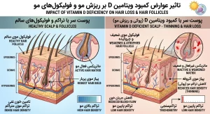 تاثیر عوارض کمبود ویتامین D بر ریزش مو و فولیکول‌های مو