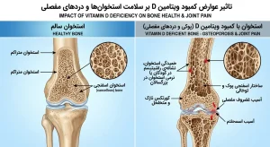 تاثیر عوارض کمبود ویتامین D بر سلامت استخوان‌ها و دردهای مفصلی