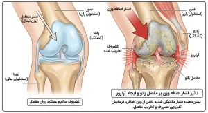 تاثیر فشار اضافه وزن بر مفصل زانو و ایجاد آرتروز