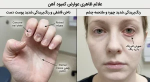 علائم ظاهری عوارض کمبود آهن روی ناخن قاشقی و پوست صورت
