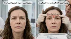 بررسی افتادگی پلک و عدم تقارن ابروها به عنوان عوارض ناشی از تزریق نادرست بوتاکس