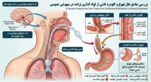 بررسی علل تهوع و گلودرد ناشی از لوله‌گذاری تراشه در بیهوشی عمومی
