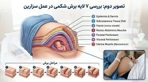 بررسی ۷ لایه برش شکمی در عمل سزارین