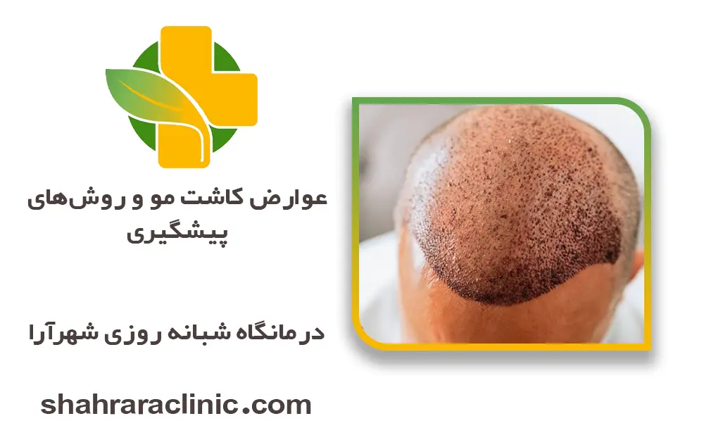 عوارض کاشت مو و روش‌های پیشگیری
